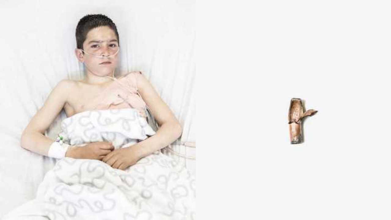 Kabul, Afghanistan. Haki Mullaha, 10 anni, ferito dall'esplosione di un vecchio proiettile gettato nel fuoco.