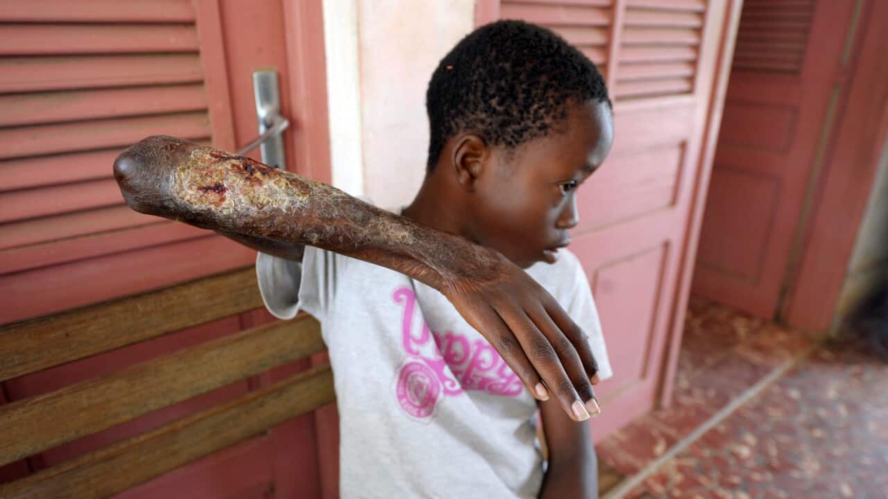 A young boy in the Ivory Coast shows his arm skin damaged by Buruli ulcer, also known as the Bairnsdale ulcer or Searl ulcer, as he waits to get treatment on September 12, 2009.