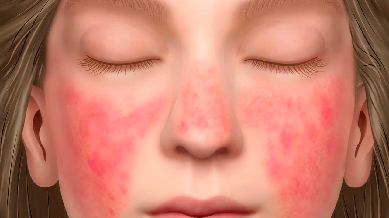 Face with lupus erythematosus, illustration