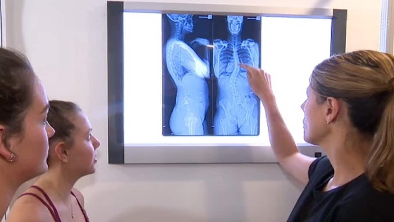 An x-ray showing a case of scoliosis
