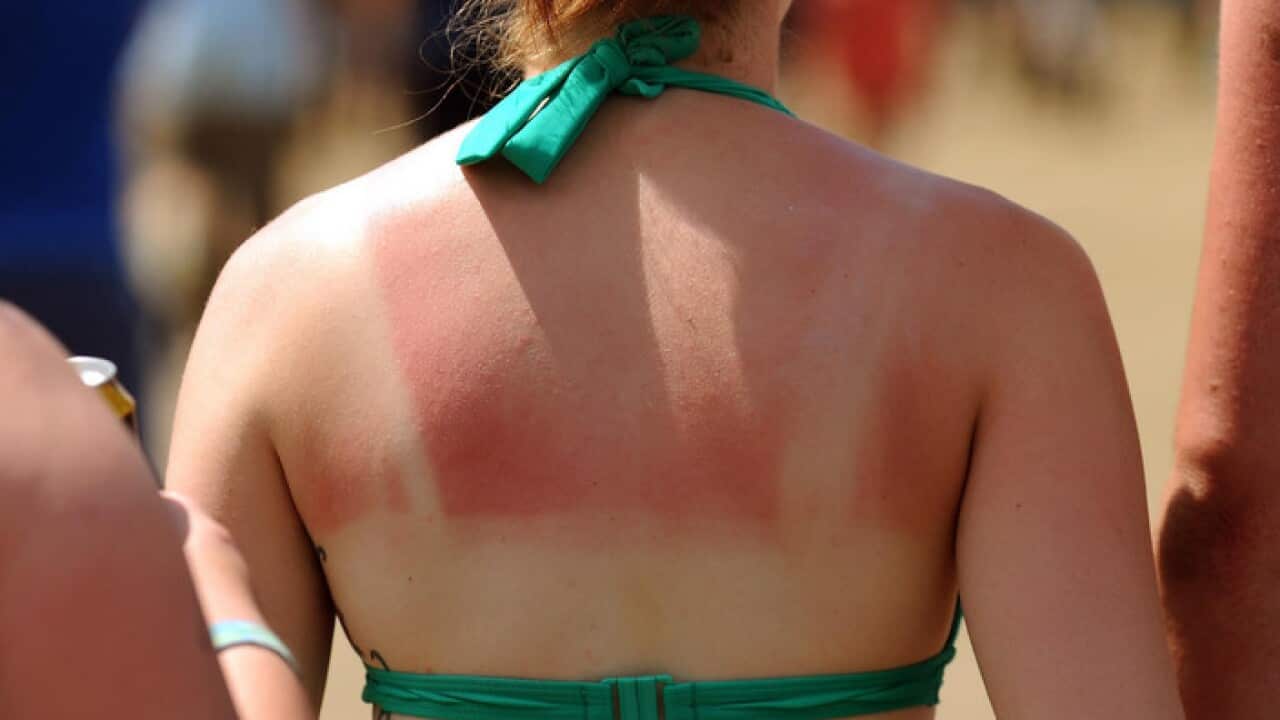 A woman with a sunburnt back