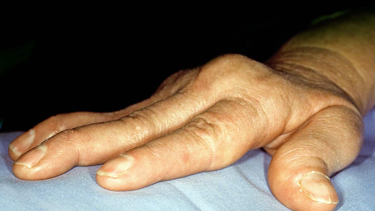 Rheumatoid arthritis