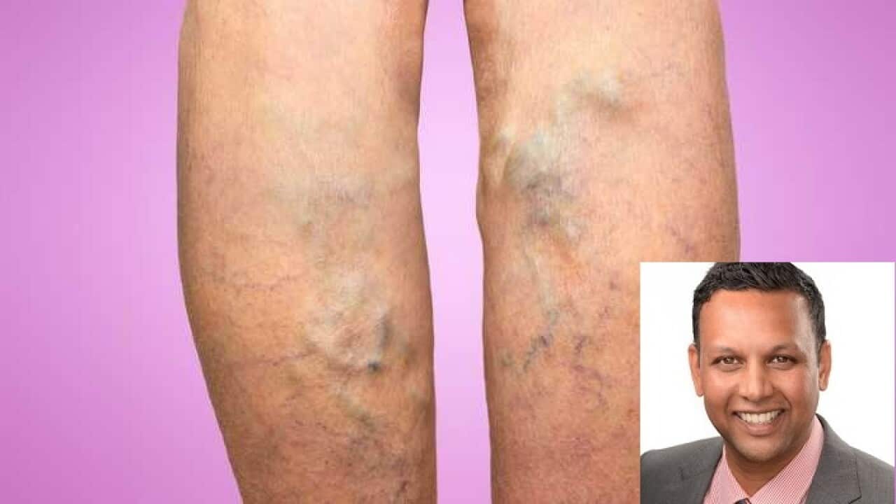 varicose vein-vena seal treatment
