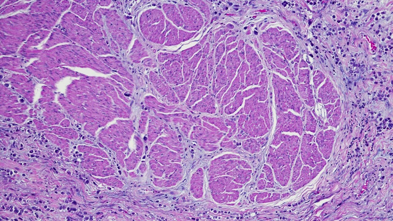 Plasmacytoid variant of urothelial carcinoma