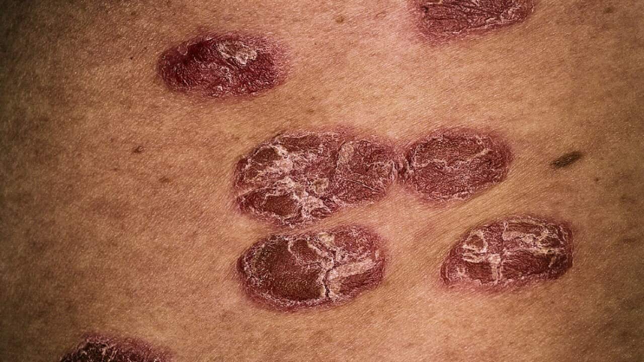 HEALTH PSORIASIS
