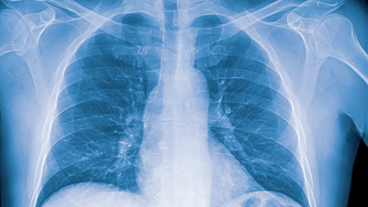 X-ray image of lung with pneumonia