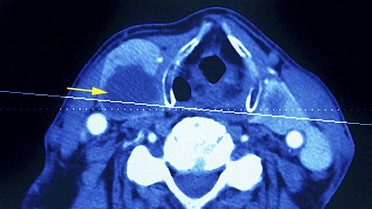 Thyroid Nodule, Scan