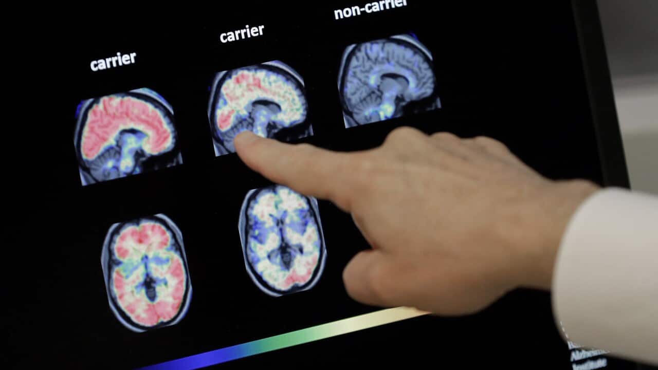 A PET brain scan from a US Alzheimer's Institute