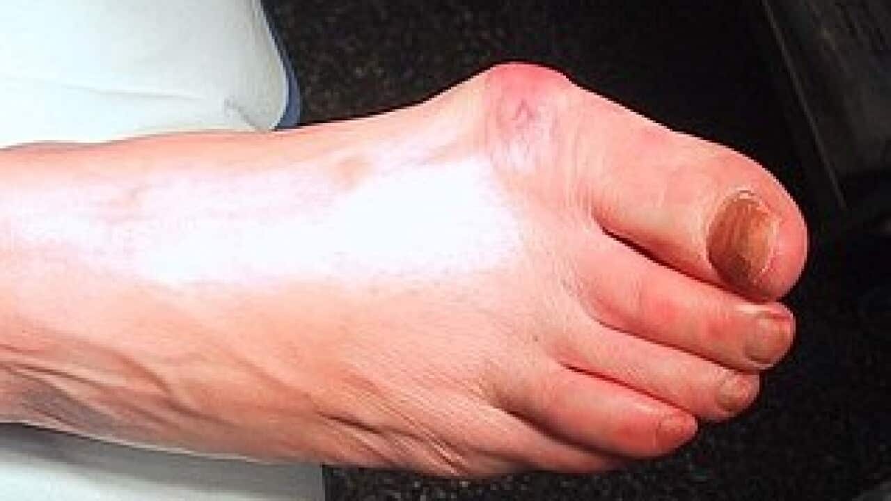 u ngón chân cái.jpg