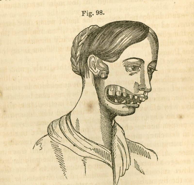 Phossy jaw