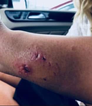 Katarina Zarutskie's injury.