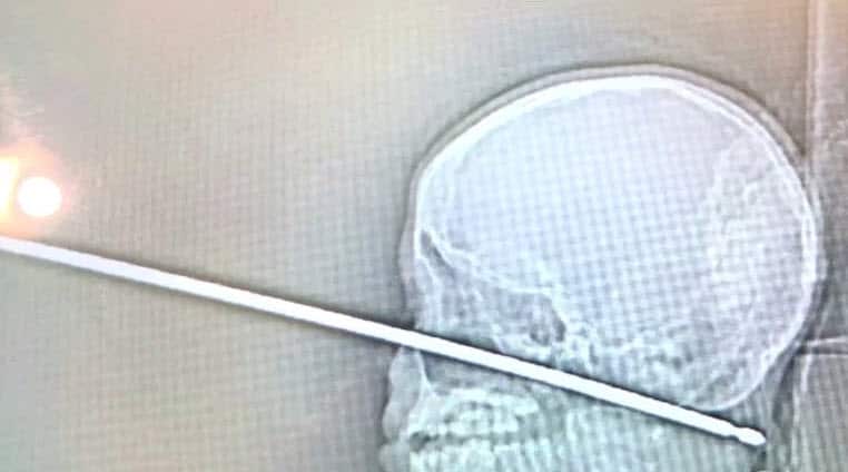 X-ray of a skewer that pierced the skull of Xavier Cunningham.