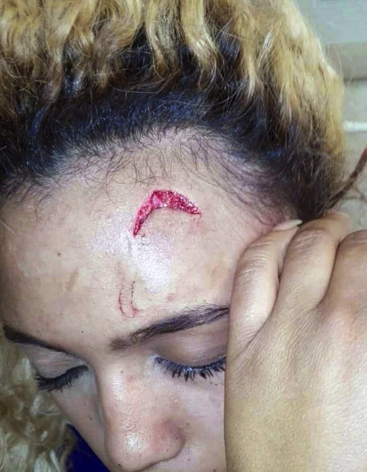 In this photo provided by Debbie Engels and taken on Monday, Aug. 14, 2017, Gabriella Engels is seen with an injury to her forehead in Johannesburg