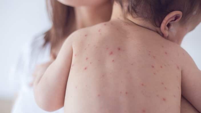 measles