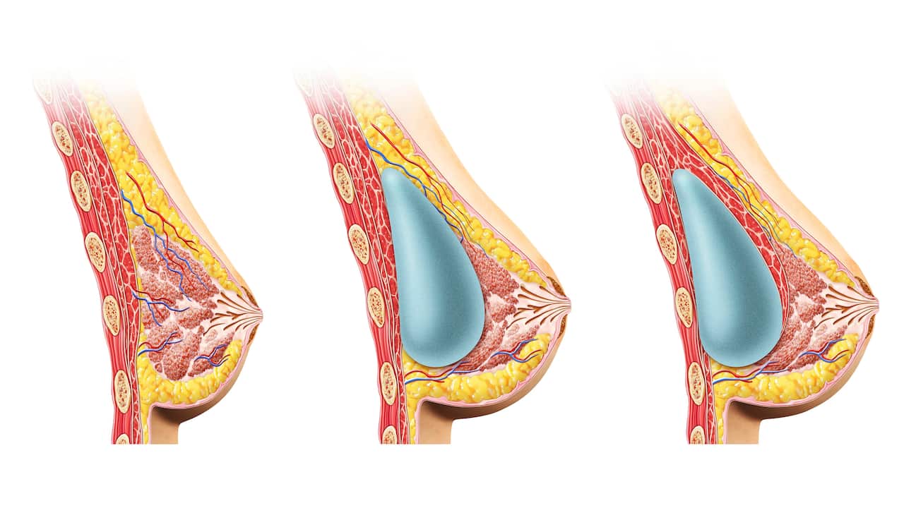 Female breast implant graphics