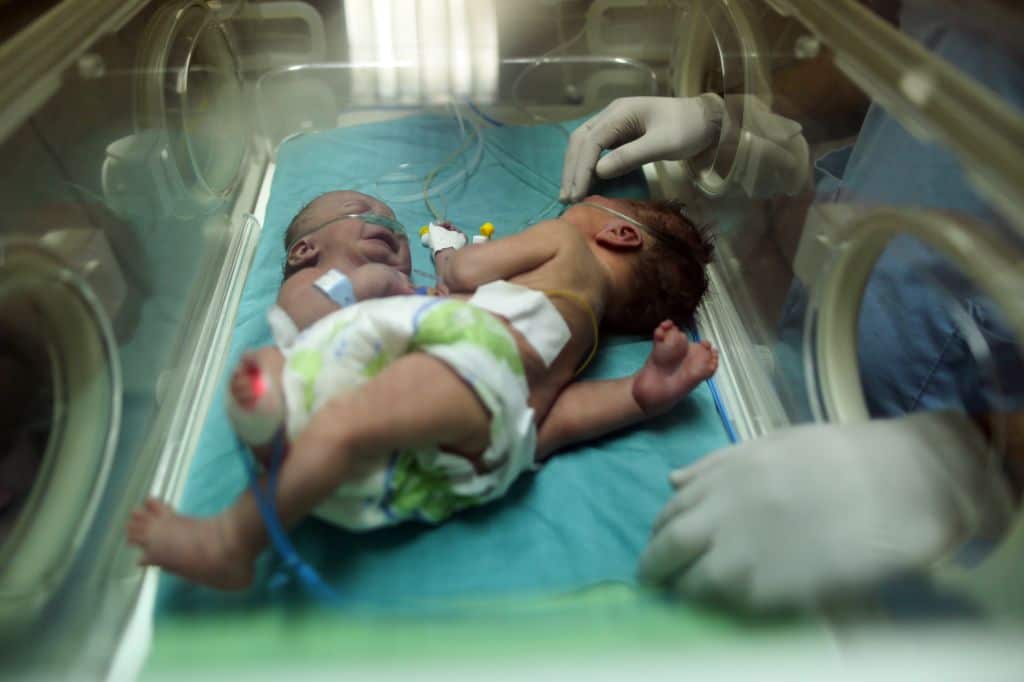 One-day-old Palestinian conjoined twins lie in an incubator at the nursery on October 22, 2017 at al-Shifa Hospital in Gaza City. / AFP PHOTO / MAHMUD HAMS (Photo credit should read MAHMUD HAMS/AFP/Getty Images)