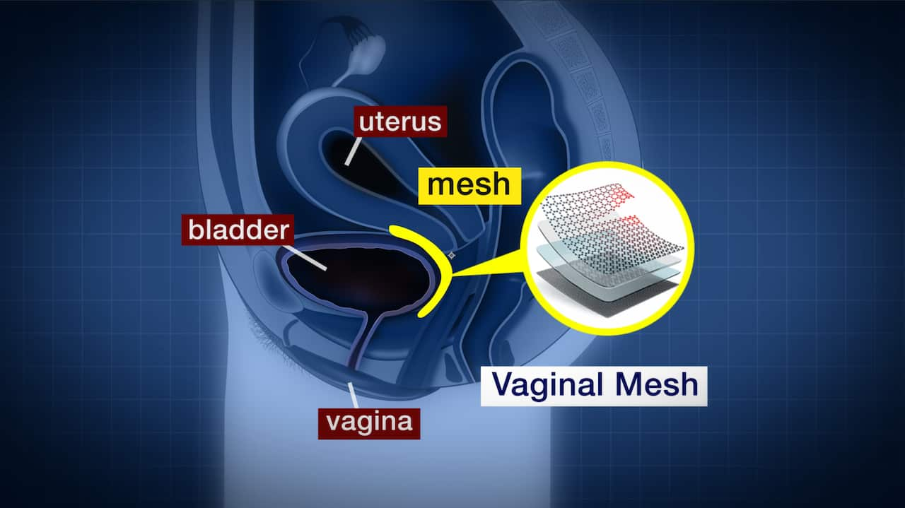 Vaginal Mesh Implants Lawsuit Against Johnson And Johnson Set To