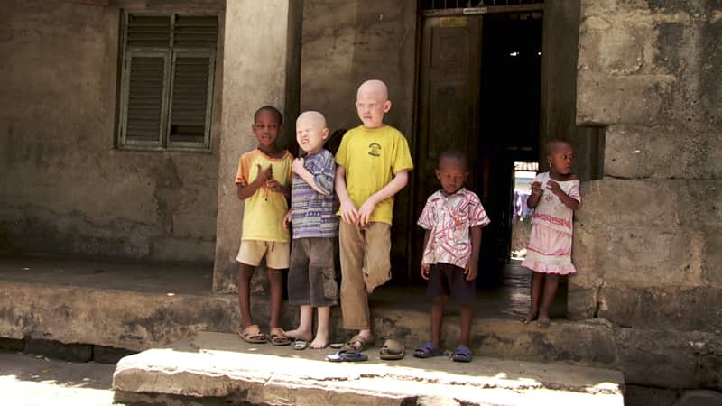 Skin cancers and disease mean that most people with Albinism in East Africa die before the age of 40 (Aaron Lewis)