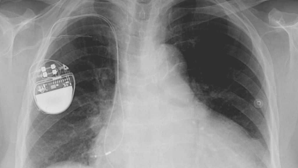 Faulty medical devices have reportedly been used widely due to lax regulation in Europe, a lack of transparency, and poor regulation.