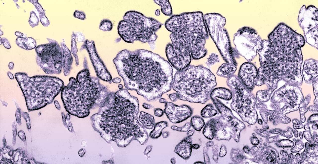 The Nipah virus in the Cerebrospinal fluid of an infected patient.