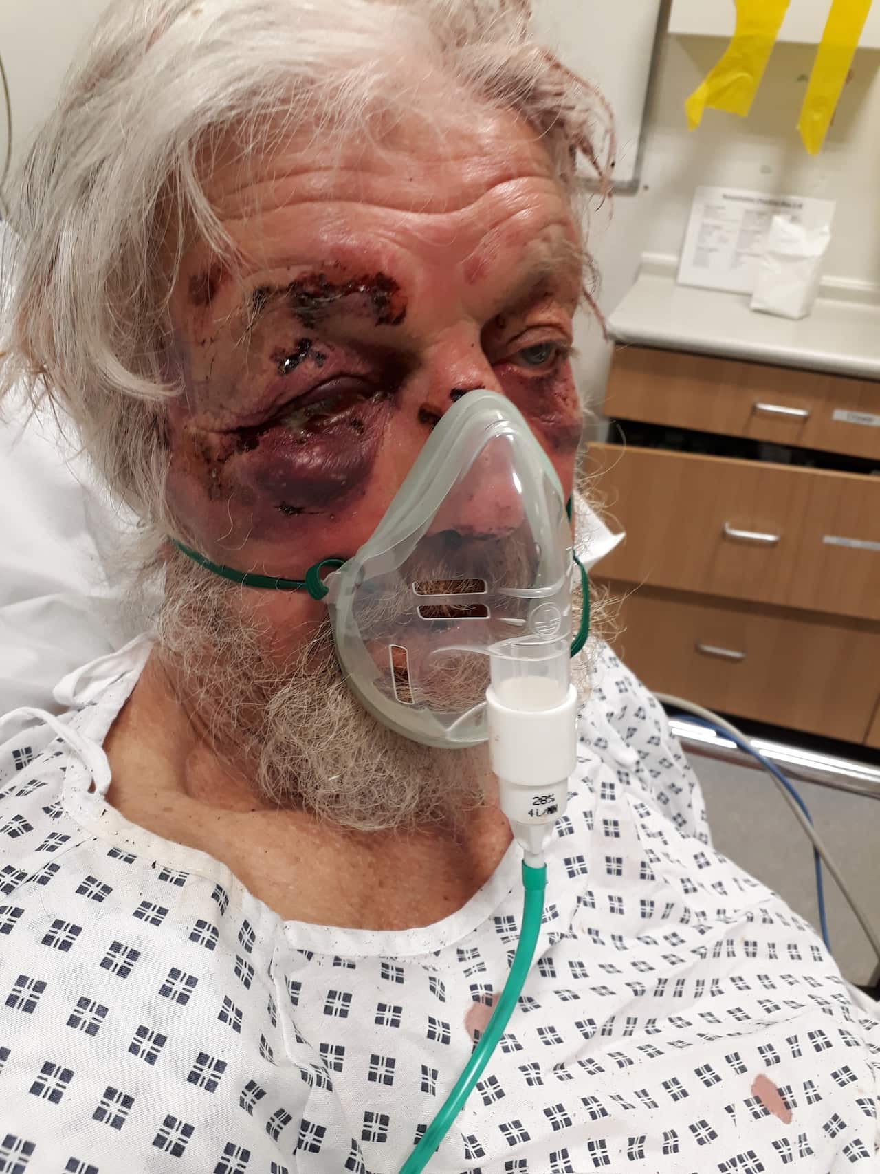 The victim's injuries.