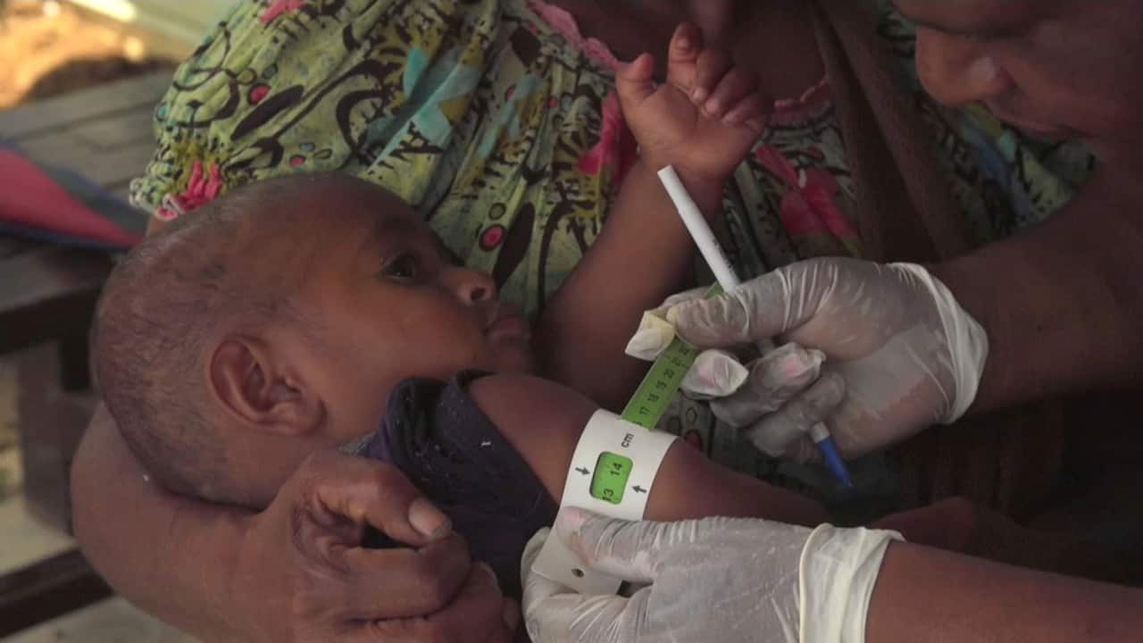 Malnutrition is a persistent issue in parts of PNG.