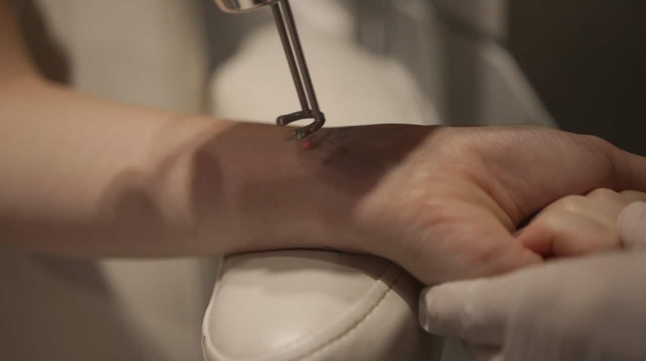Matt says tattoo removal laser machines range in price from $150,00 - $300,000.