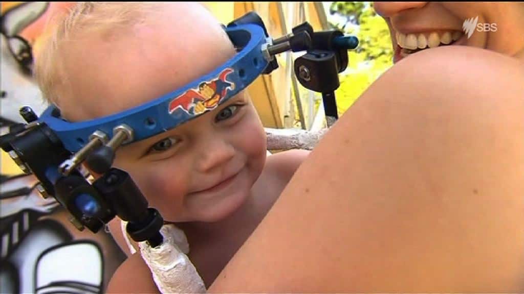 Jaxon Taylor, 16 months, who has survived a surgery to reattach his head to his spine.
