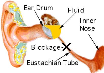 otitis media blockage