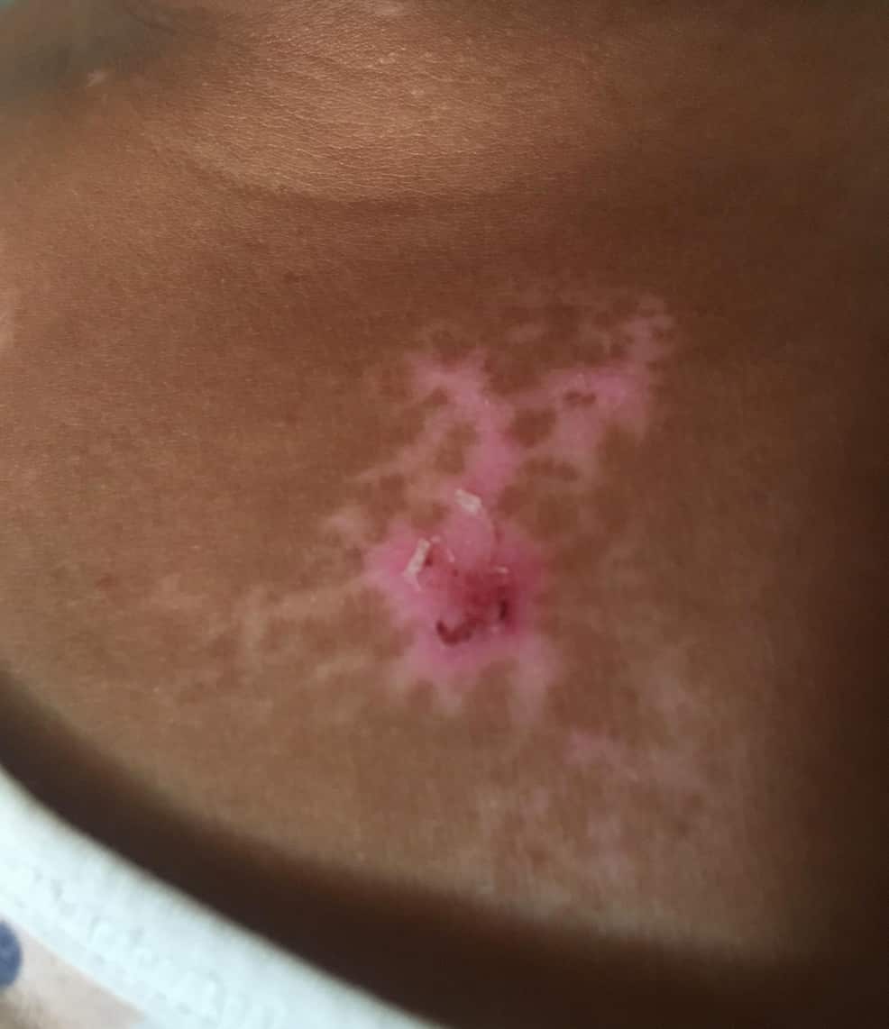 Vitiligo