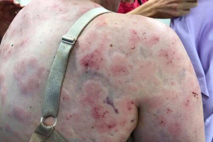 Mother Fiona Simpson was badly injured after being pelted by hail
