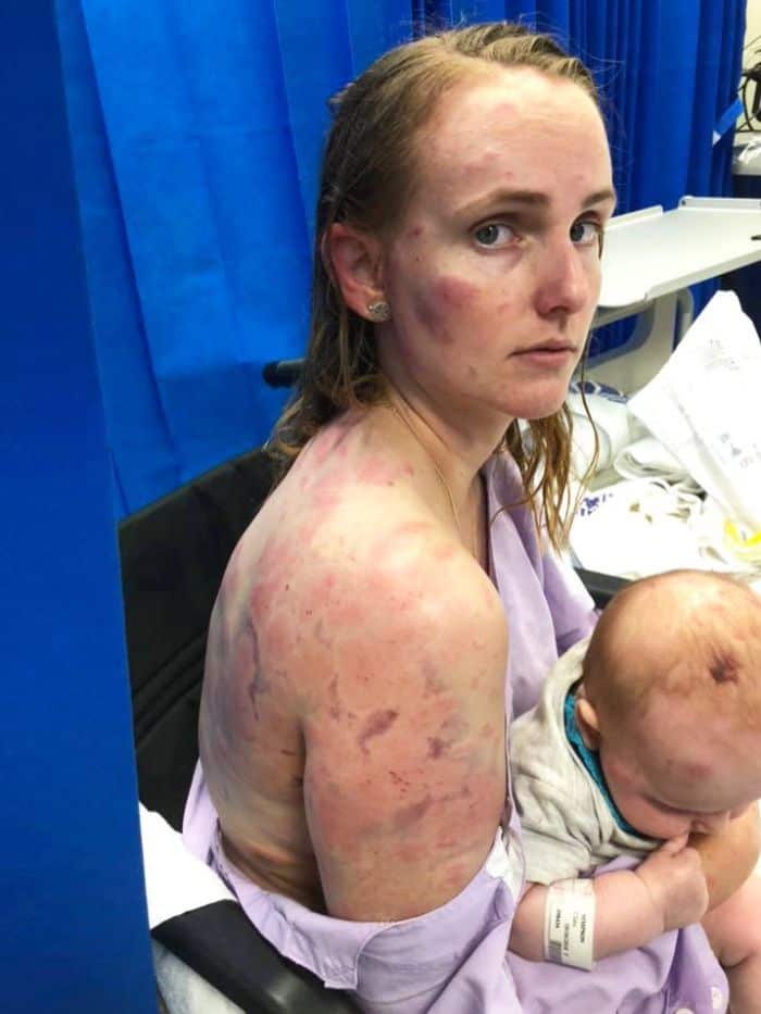 Mother Fiona Simpson was badly injured after being pelted by hail