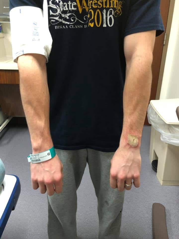 A man claims he sustained third-degree burns when his Fitbit exploded in his sleep