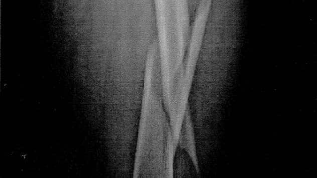 An x-ray taken shortly after the incident revealed Mr Crossley's left femur was broken