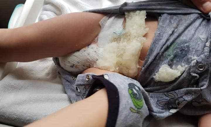 Huggies nappy exploded on Sydney's kid