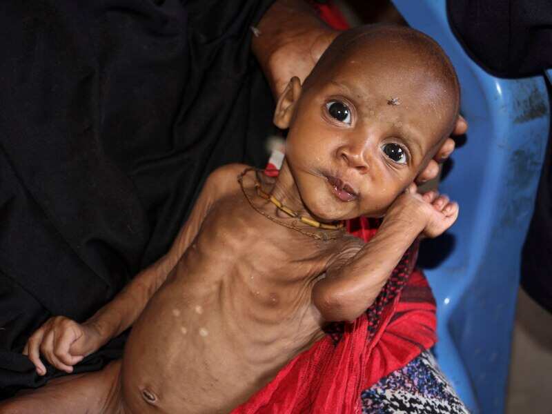 Malnourished baby Ali Hassan who fled the drought in Somalia