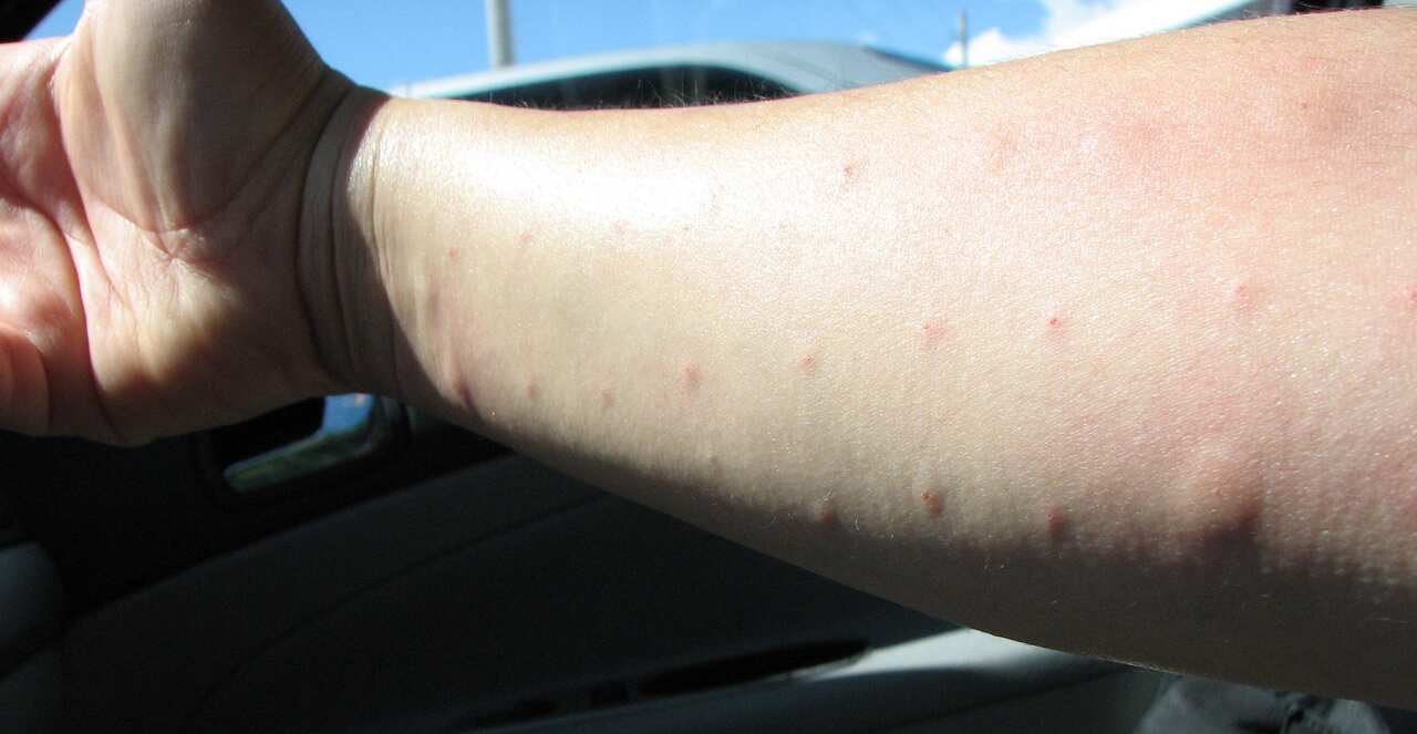 allergy