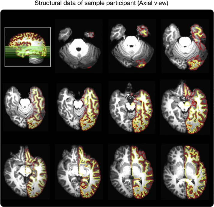 Source: NeuroImage, Dr James Hartzell/ Center for Mind/Brain Sciences (CIMeC) Italy/National Brain Research Centre, (NBRC) India