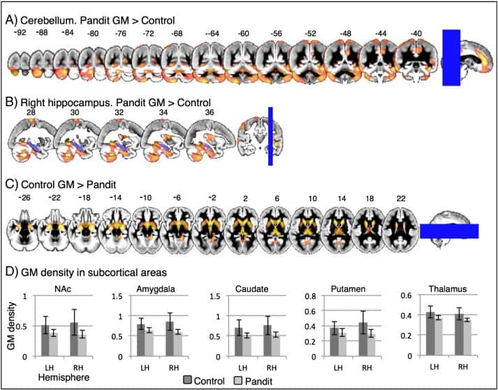 Source: NeuroImage, Dr James Hartzell/ Center for Mind/Brain Sciences (CIMeC) Italy/National Brain Research Centre, (NBRC) India