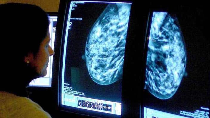 breast cancer