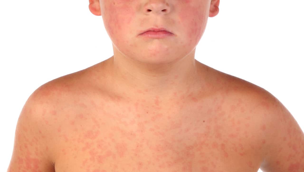 A sick young boy with a red rash all over his face and body