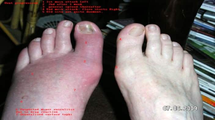 Gout
