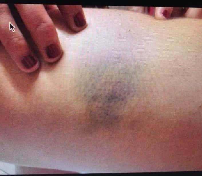 domestic abuse bruises