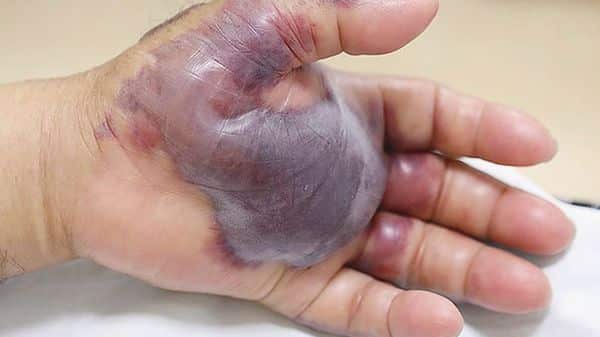 A 71-year-old South Korean had to have his left hand amputated after eating sushi (New England Journal of Medicine)