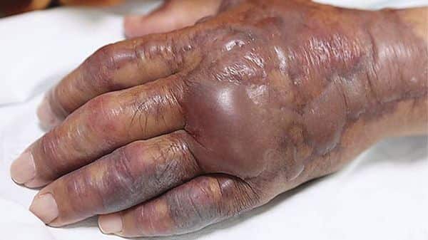 A South Korean man an infection called vibriosis caused by the Vibro vulnificus bacteria which he picked up eating sushi