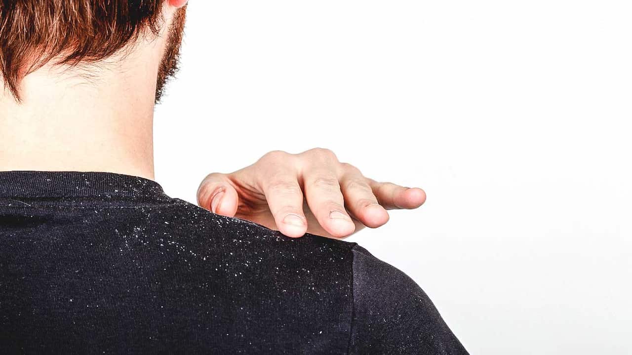 Is dandruff contagious?
