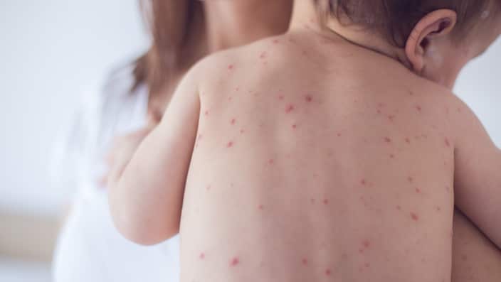 Mother taking care of baby with chicken pox
