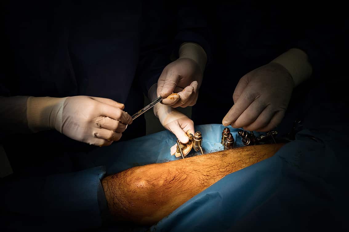 GAZA. 4th March 2020. Surgeons prepare to operate on Ismail Abu Wared. Al-Awda, hospital patients suffering from osteomyelitis are kept in isolation rooms to treat infection. No new bone plantations can be performed while the infection is present.