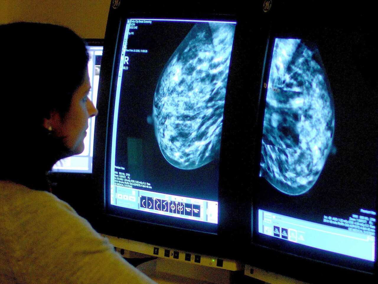 Doctors hope saliva test could revolutionise breast cancer treatment
