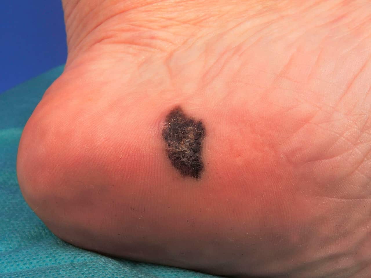 Acral lentiginous melanoma of the sole, level 1. (Photo by: BSIP/Universal Images Group via Getty Images)